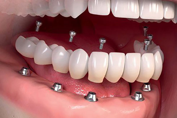 Implantes