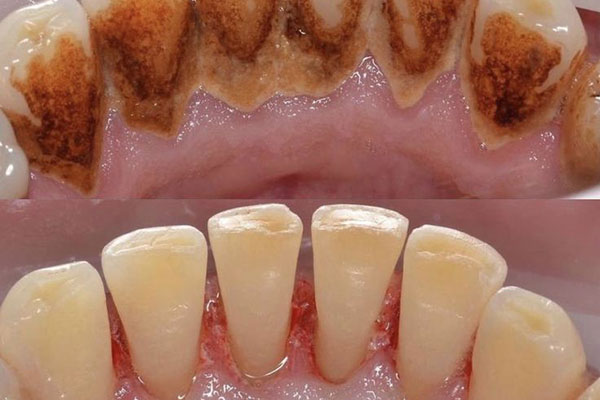 Periodoncia